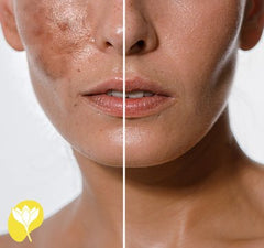 Melanin Nedir, Cilde Etkileri Nelerdir? görsel